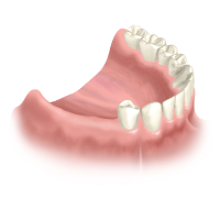 Отсутствие части зубов верхней или нижней челюсти