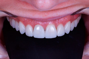 Реставрация зубов изображение 1