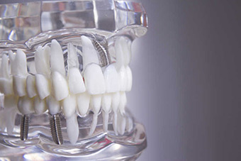 Базальная имплантация зубов Foto_1_1