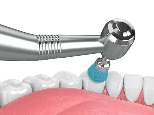 Гигиена зубов в стоматологии