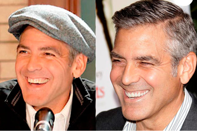 Голливудские виниры Джорджа Клуни