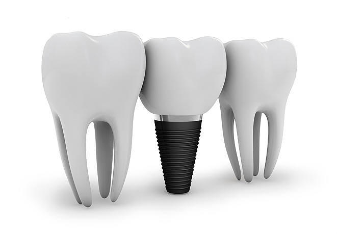 Преимущества, которые обеспечивают базальные зубные импланты