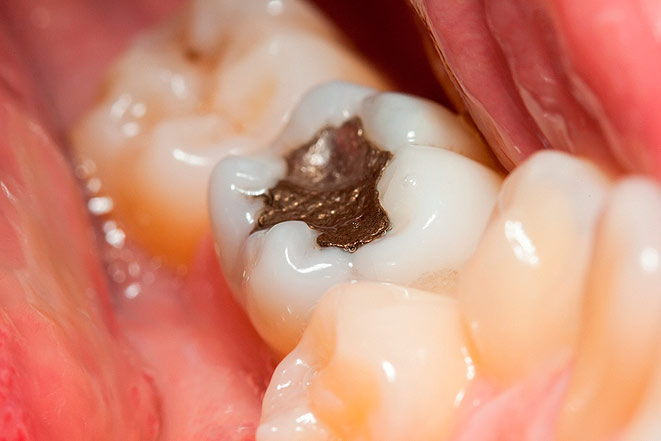Какова стоимость пломбы зуба и когда ее нужно менять