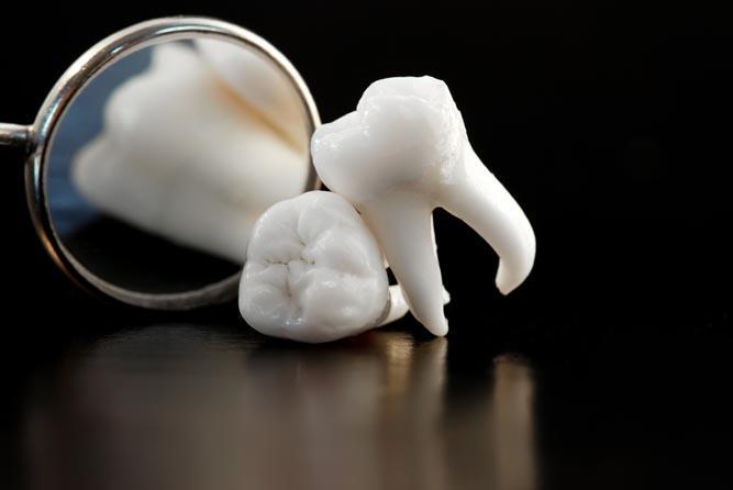 Удаление импланта зуба – причины, техника