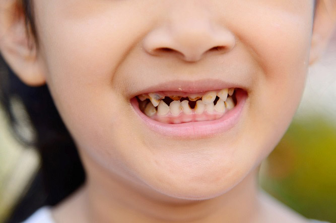 Плохое состояние зубов – причина низкой массы тела у детей и подростков