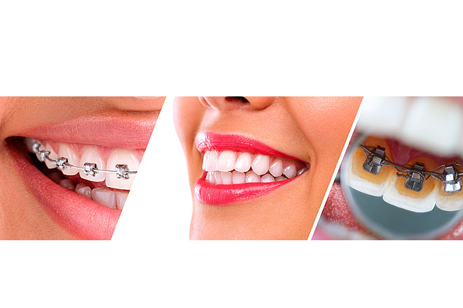 Ортодонтическое разнообразие: какие бывают брекеты