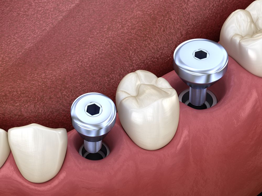 Через сколько после удаления зуба можно ставить имплант
