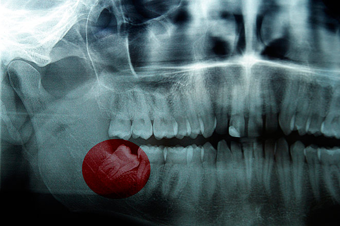 Сильно болит зуб, что делать?