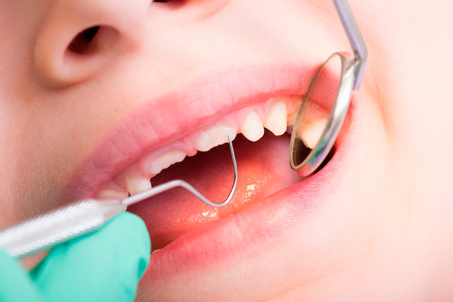 Что такое серебрение зубов