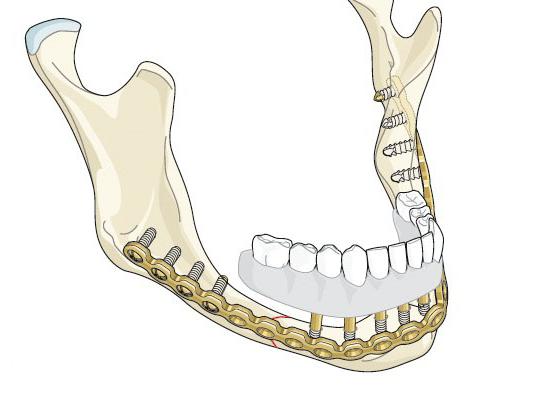 Титановые эндопротезы для восстановления челюсти