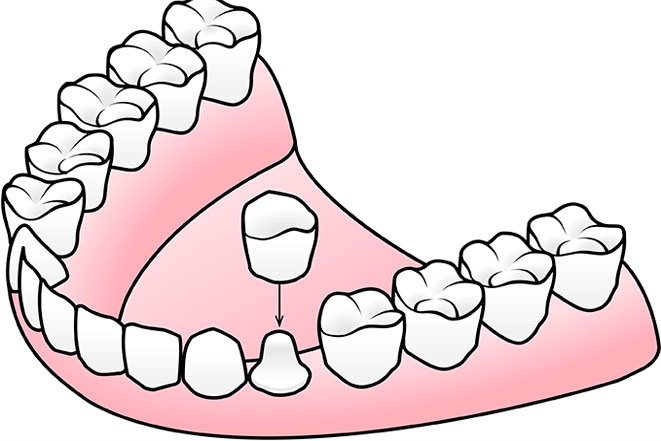 На какие зубы ставят коронки: показания к применению