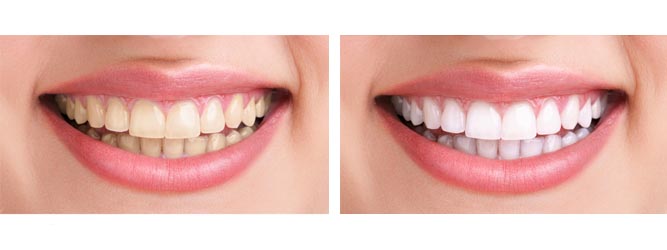 Белоснежные зубы делают человека моложе минимум на пять лет