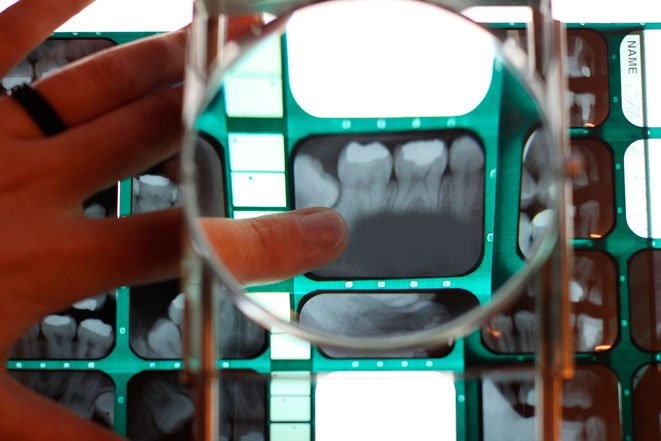 Методика удаления большой кисты зуба