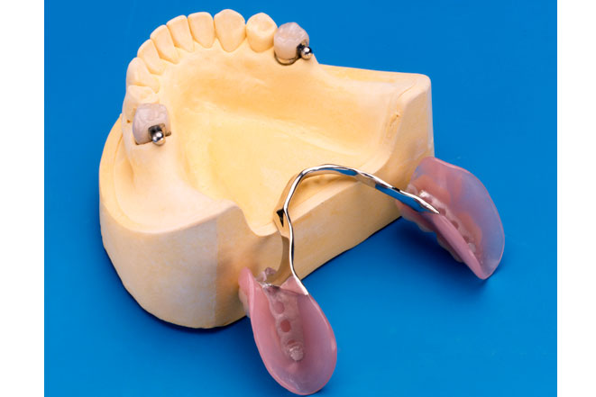 Частичные съемные зубные протезы – альтернатива дорогостоящей имплантации