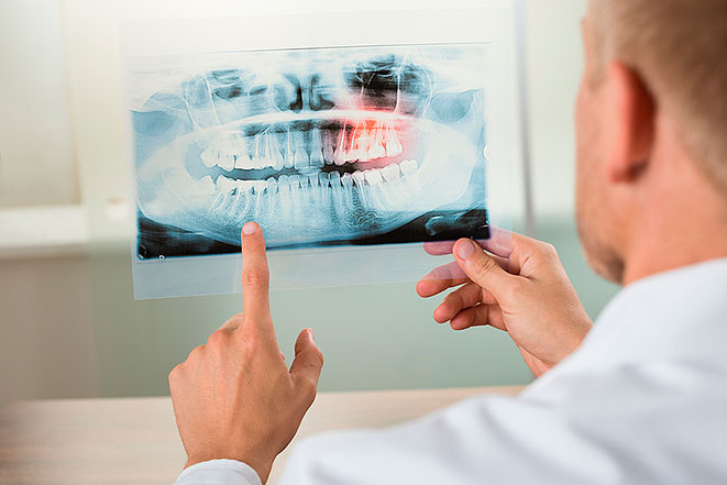 Вывих зуба: виды, симптоматика, способы лечения