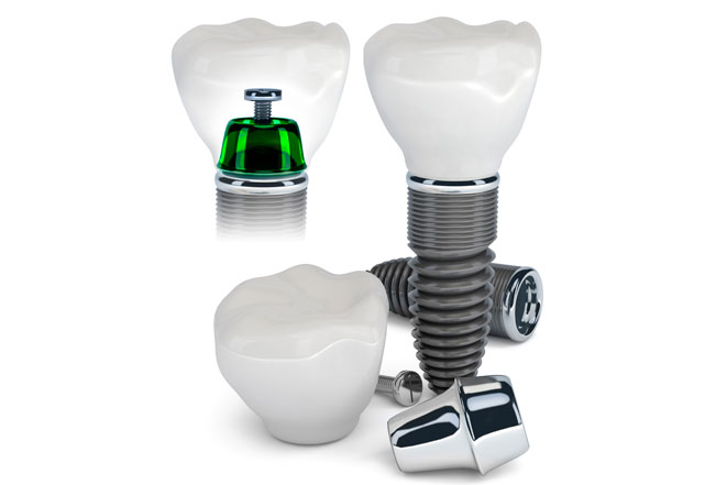 Методика имплантации зубов