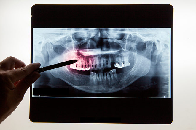 Травма зуба: причины, проявления, варианты лечения