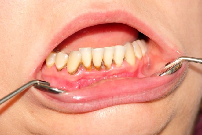 Проблемы гигиены: чем опасен зубной камень