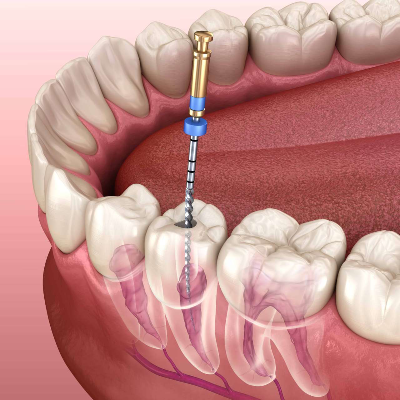 Методы удаления пульпы зуба