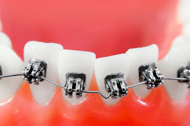 Как происходит выпрямление зубов брекетами