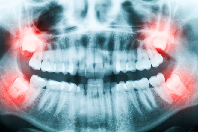 Удаление ретинированного зуба – сложная и ответственная процедура