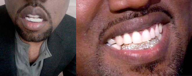 Зубы с натуральными бриллиантами шокировали поклонников Кейни Уэста