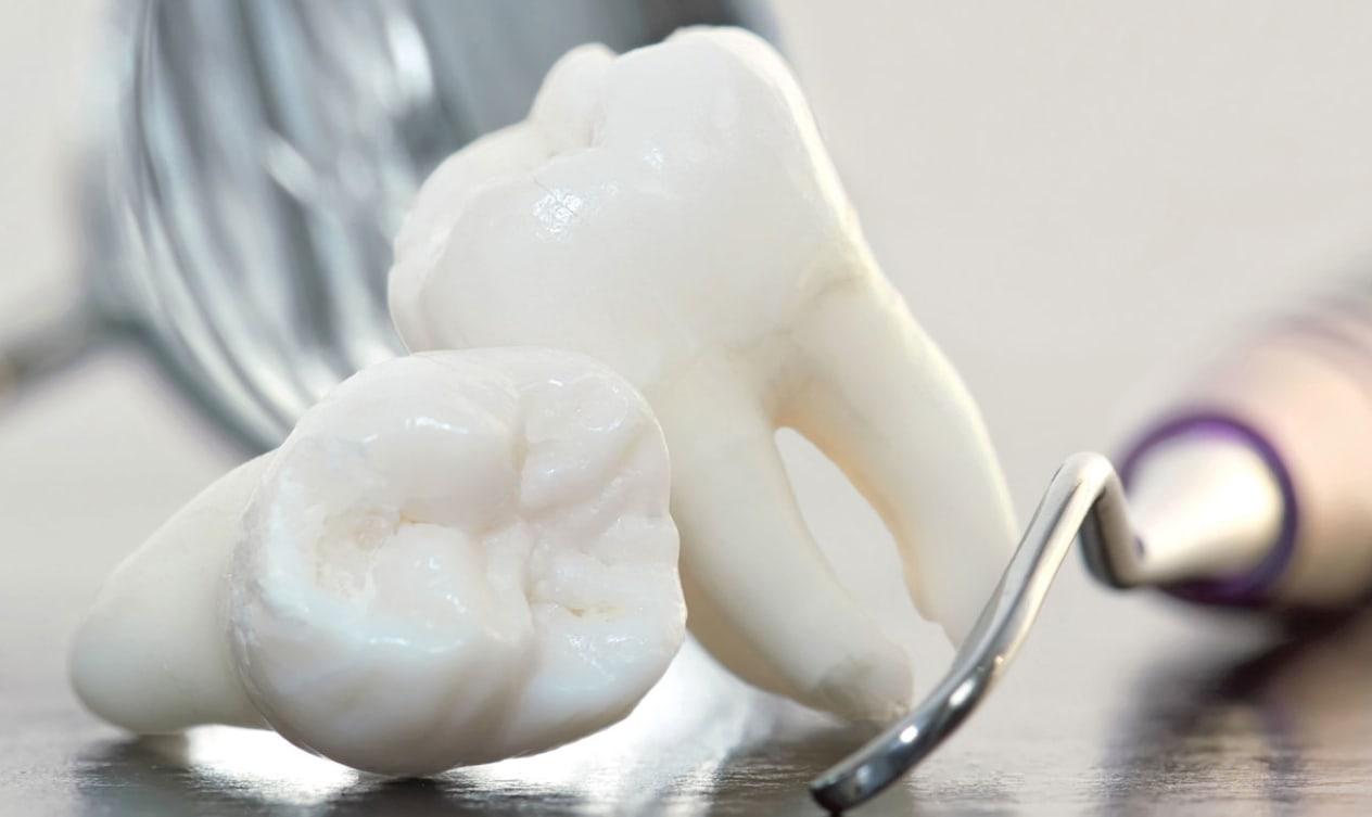 Щадящий способ восстановления зубов