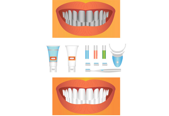 Виды отбеливания зубов: методики и  результаты