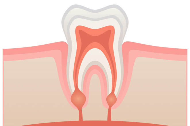 Воспаление корня зуба: причины, симптомы, способы лечения