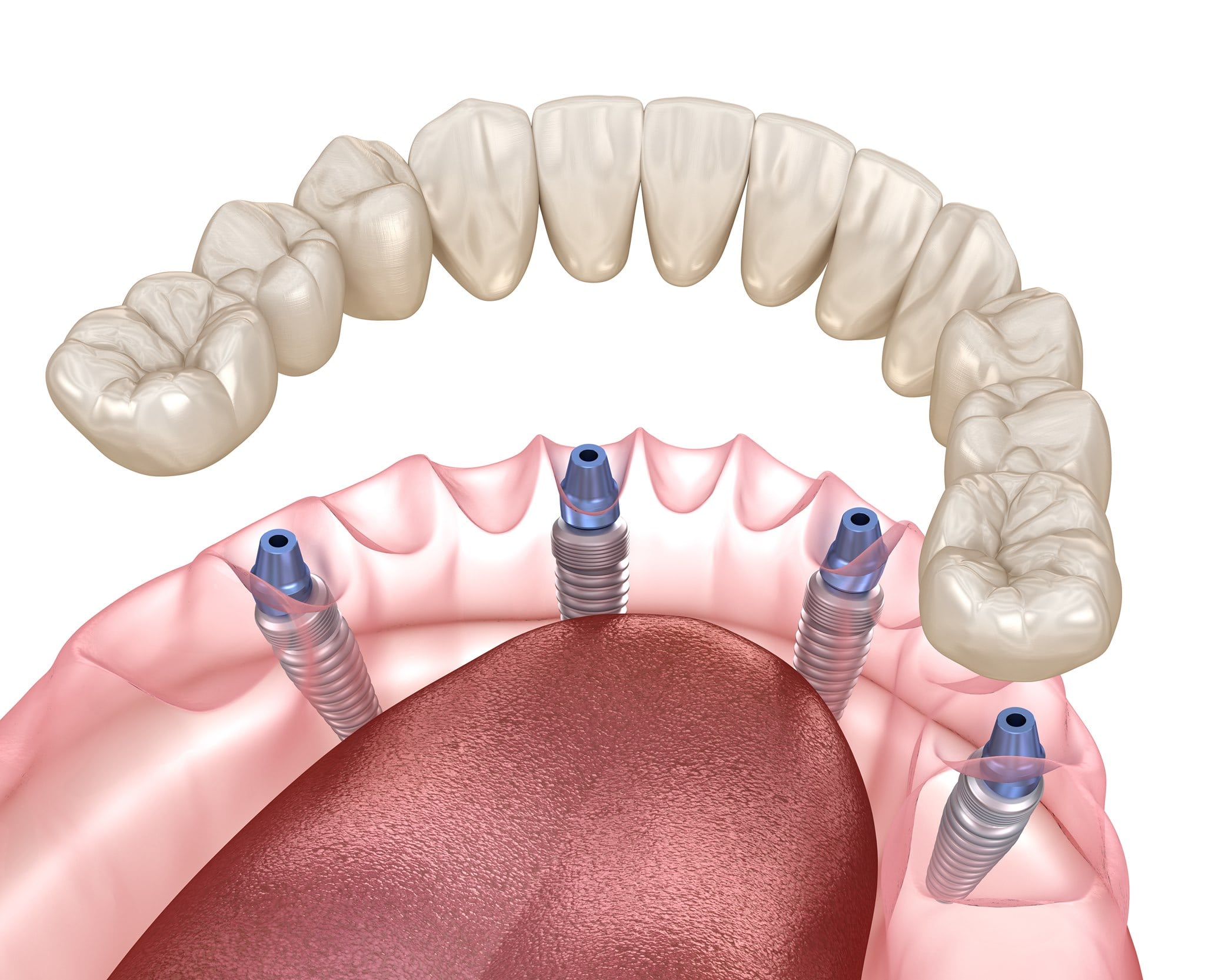 Полный зубной протез на 4 имплантах: метод All-on-4
