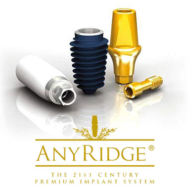 Импланты AnyRidge: отзывы и особенности имплантации