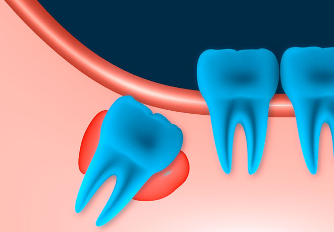 Околокорневая киста зуба