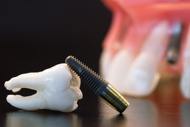 Базальная  имплантация зубов
