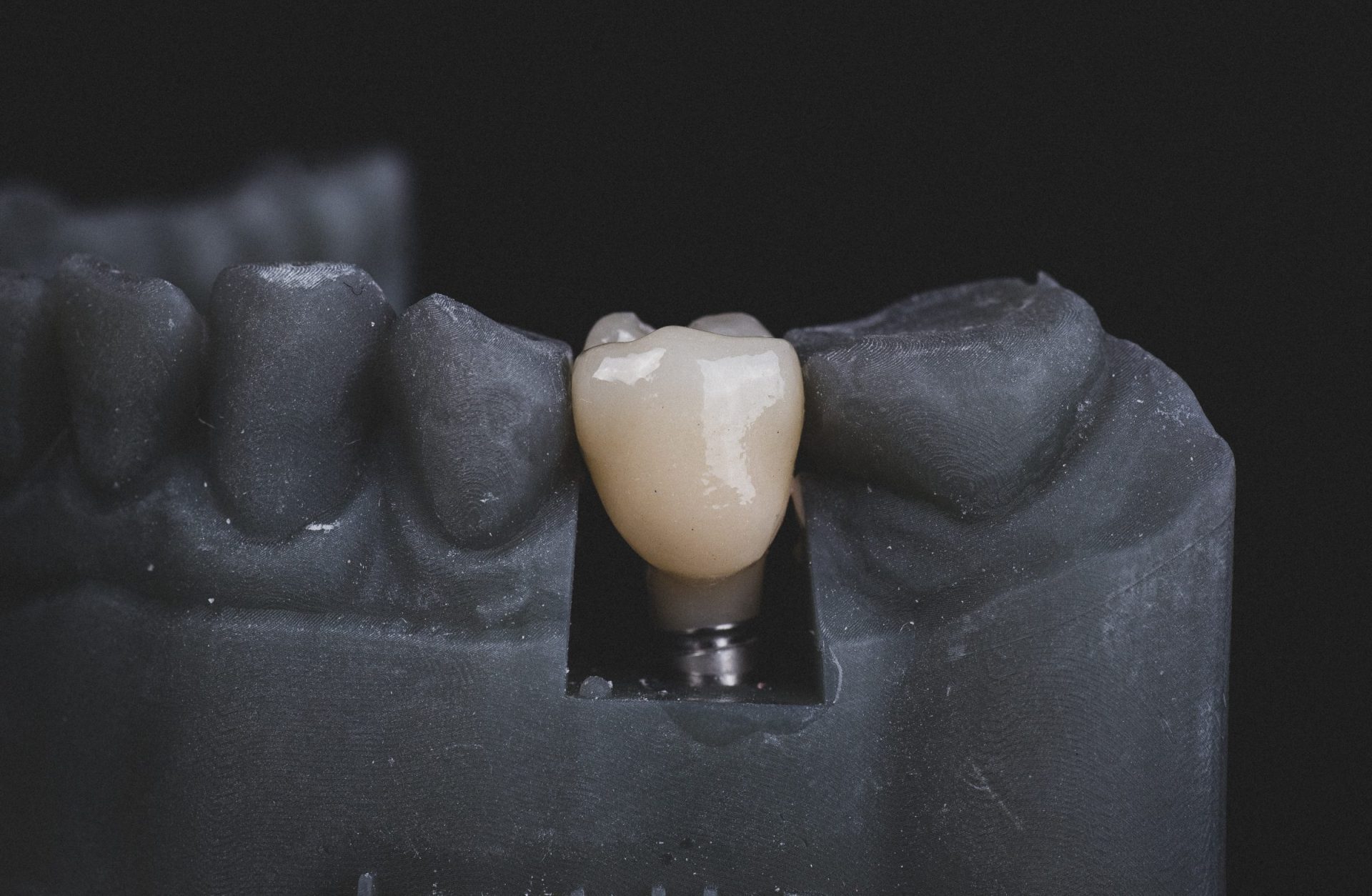 Зубной имплант – инновационная защита от кариеса