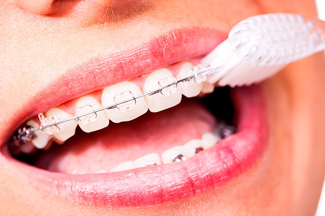 Чистка зубов фторированной пастой полезна для людей с брекетами