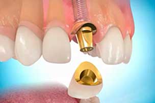 Нанотехнологии на службе стоматологии