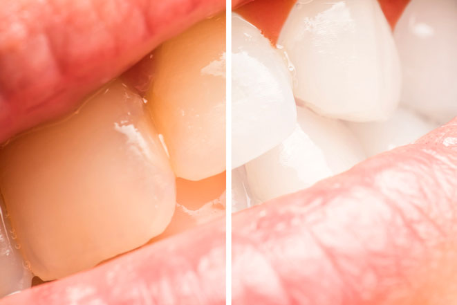Отбеливание зубов по системе Zoom – суть методики и преимущества