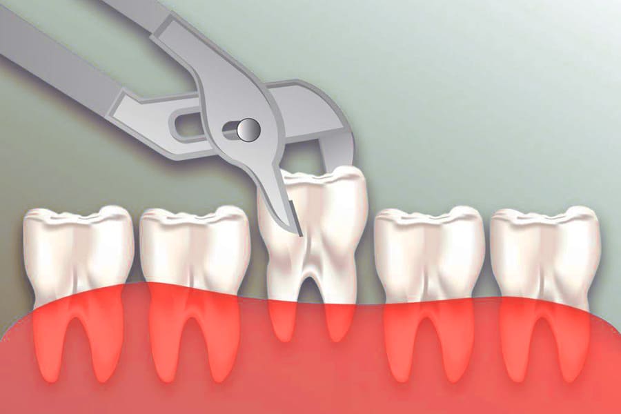 Удаление нижних зубов: методы, показания, последствия