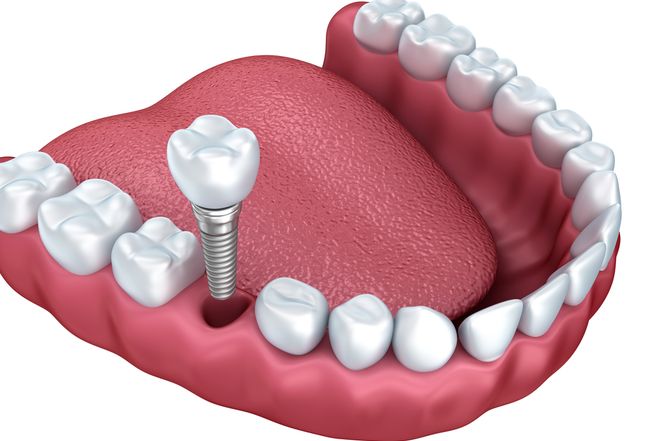 Применение титана в стоматологии