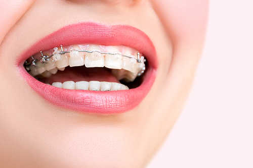 Кривые зубы: когда и как исправляют