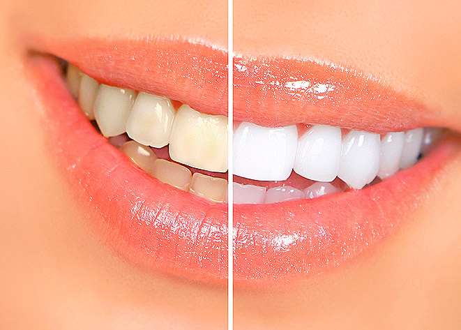 Отбеливание зубов способно принести вред организму