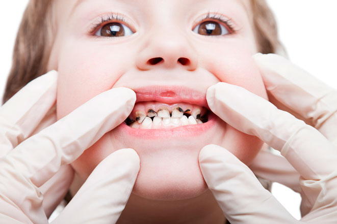 Показания и методики протезирования молочных зубов у детей