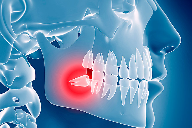 Удаление зубов не всегда проходит бесследно для пациента