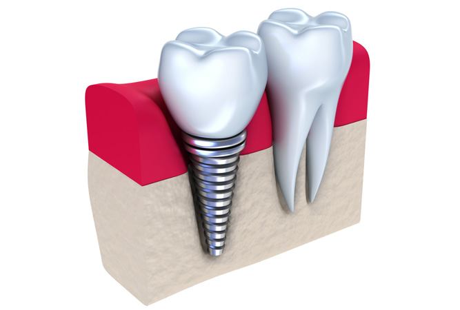 Как выбрать имплант зуба?