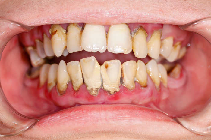 Гипоплазия зубов