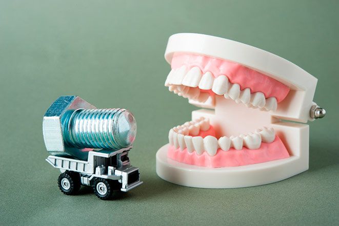 Особенности гигиены рта при имплантации зубов