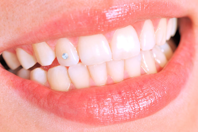 Преимущества и недостатки украшения зубов скайсами
