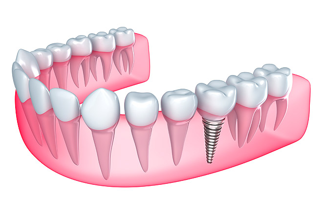 Установка импланта одного зуба