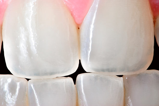 Что такое прозрачные зубы и как с этим бороться
