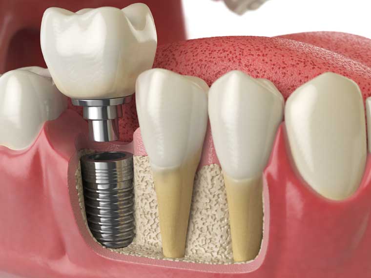 Новые технологии снизят риск отторжения зубных имплантатов
